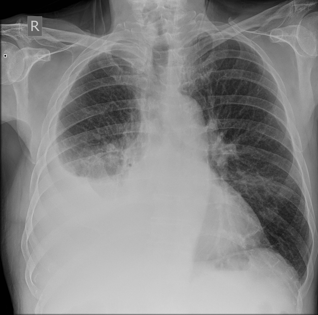 Pleural effusion