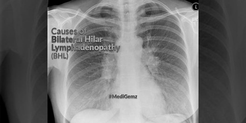 Causes Of Bilateral Hilar Lymphadenopathy Medical Gems