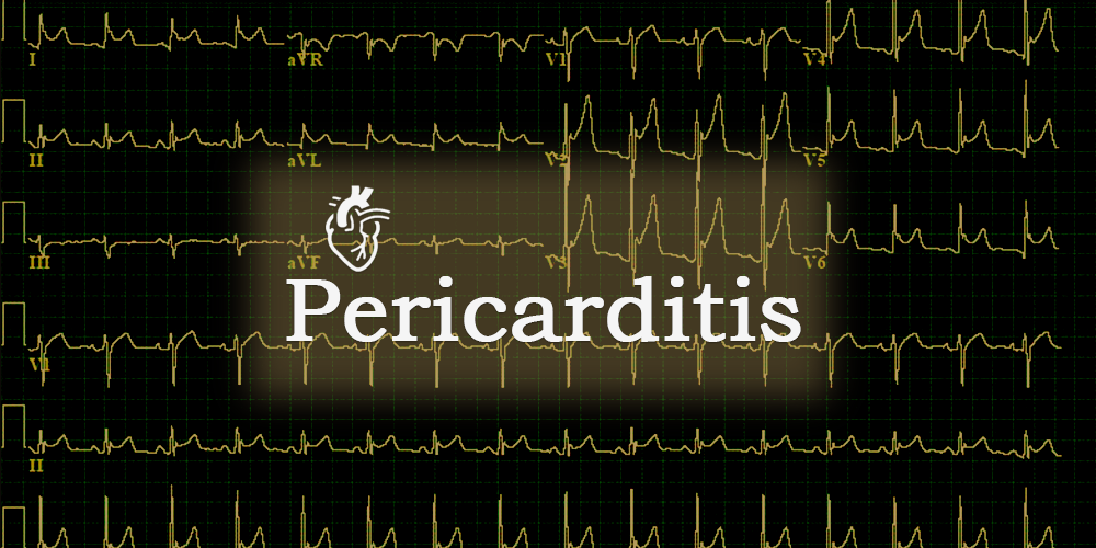 Acute pericarditis