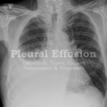 Pleural effusion