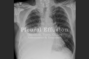 Pleural effusion