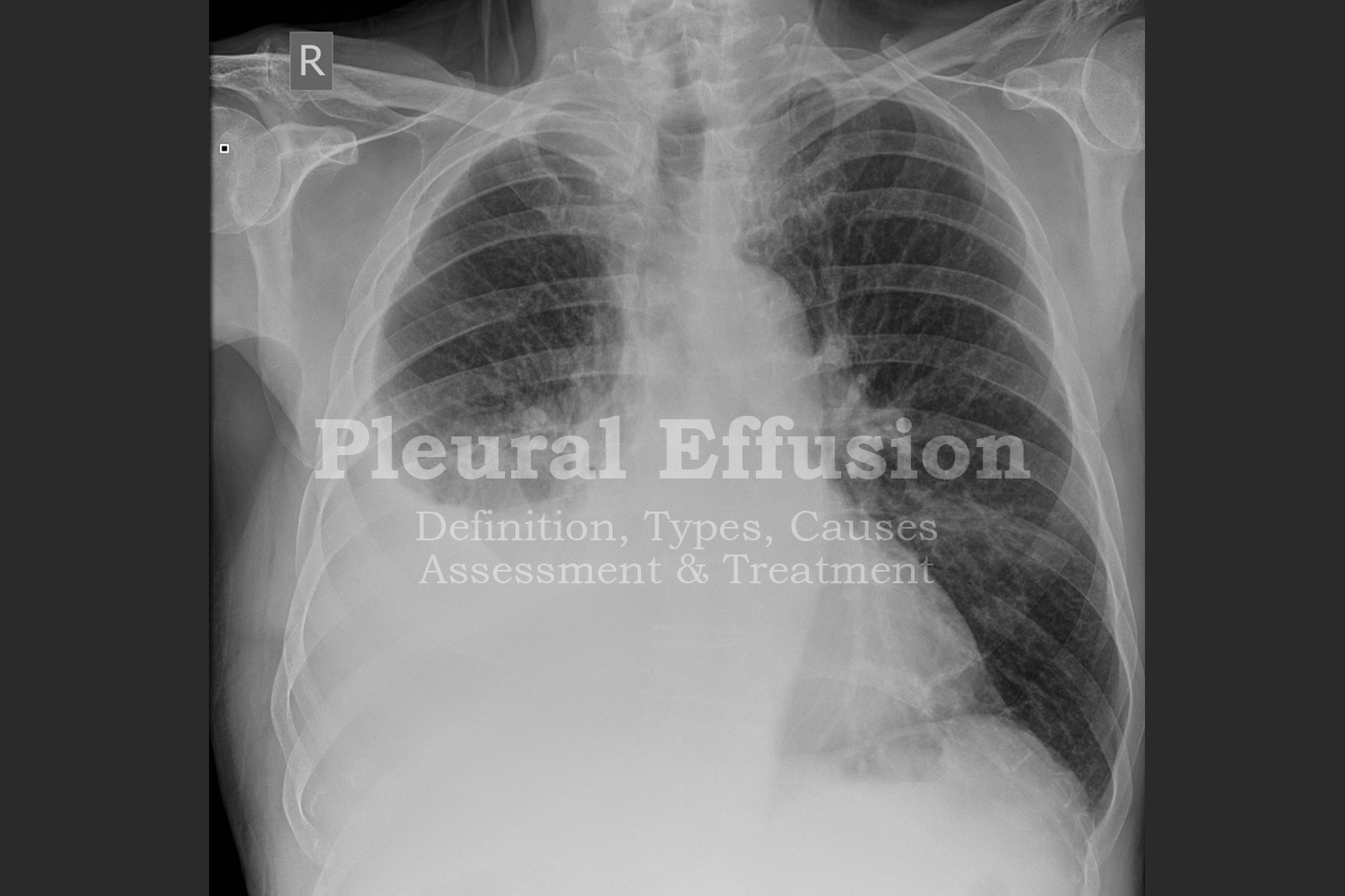 pleural-effusion-all-that-you-need-to-know-before-the-exam-medical-gems