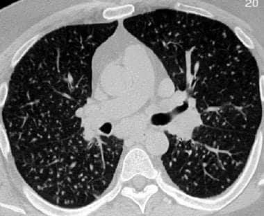 HRCT in sarcoidosis