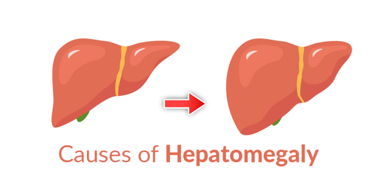 causes of enlarged liver