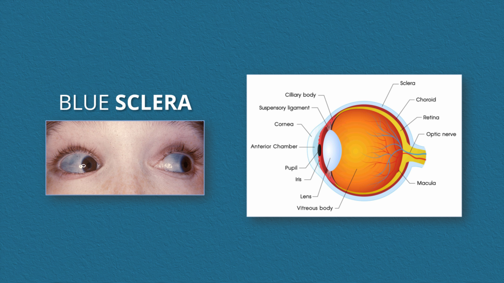 Causes of Blue sclera