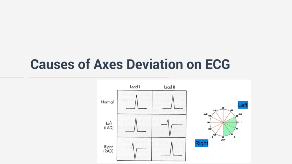 Axis deviation on ECG