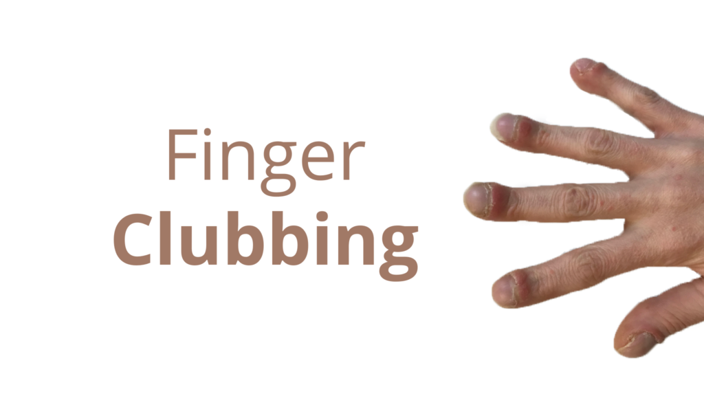 Finger clubbing