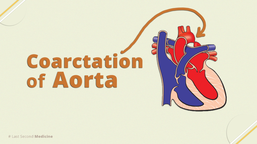 Aortic Coarctation