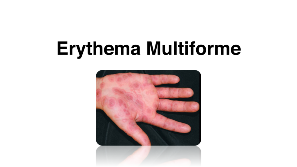 erythema multiforme