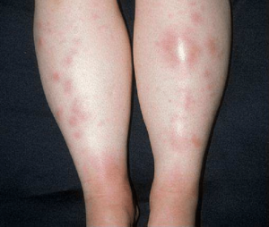 erythema nodosum