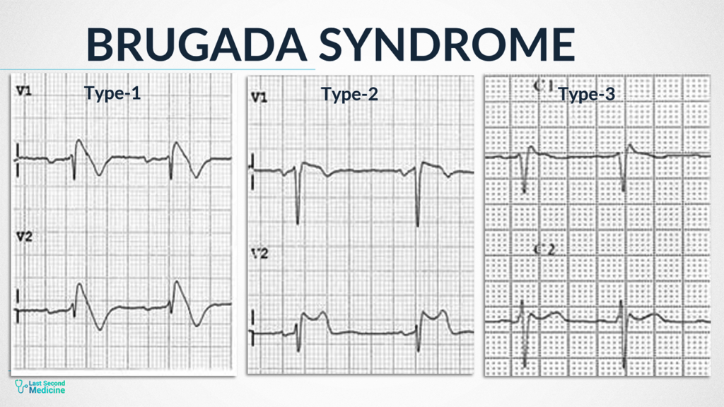 Brugada syndrome