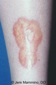 necrobiosis lipoidica diabeticorum