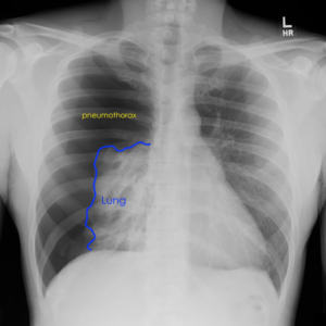 pneumothorax cxr