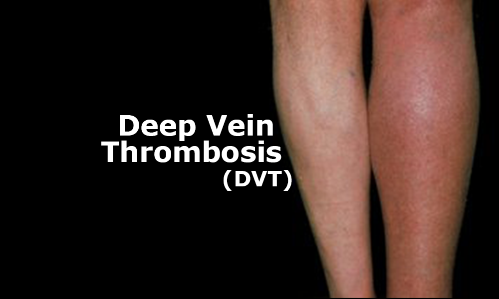 deep vein thrombosis