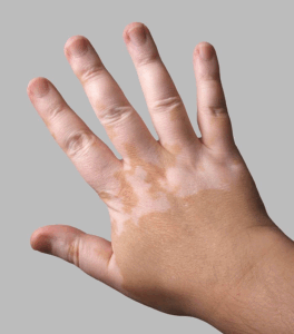 vitiligo