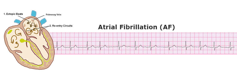 Atrial fibrillation