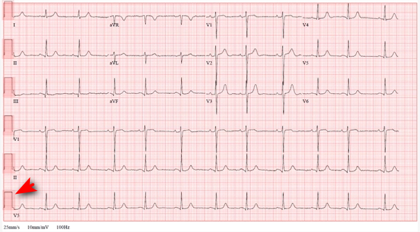 ECG voltage