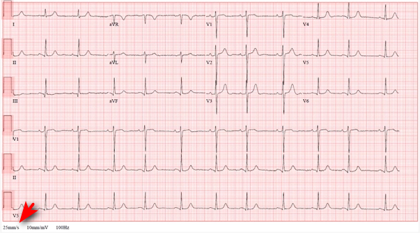 ECG paper speed