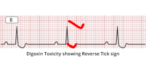 Digoxin toxicity