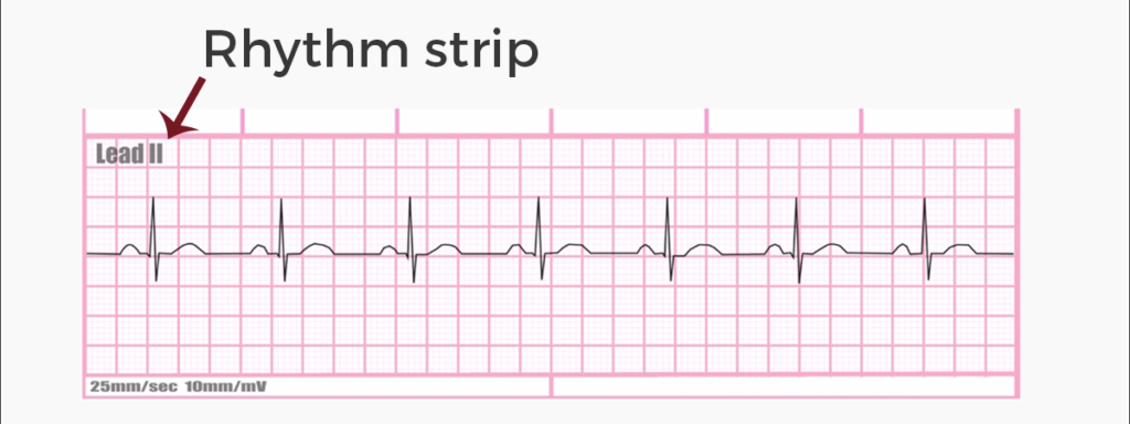 ECG rhythm strip