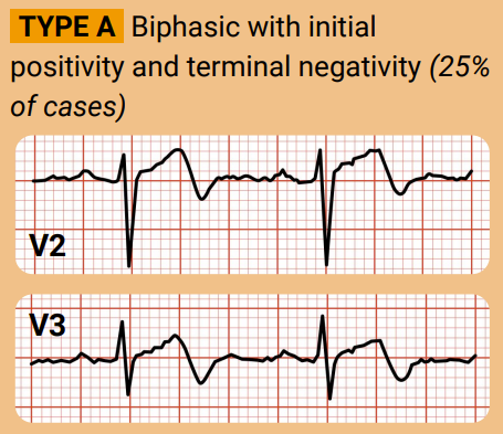 wellens syndrome