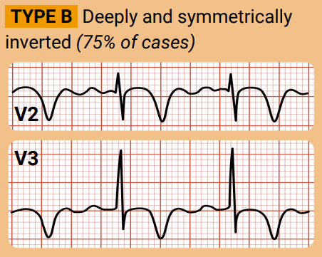 wellens' syndrome