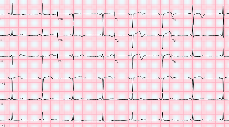 wellen syndrome